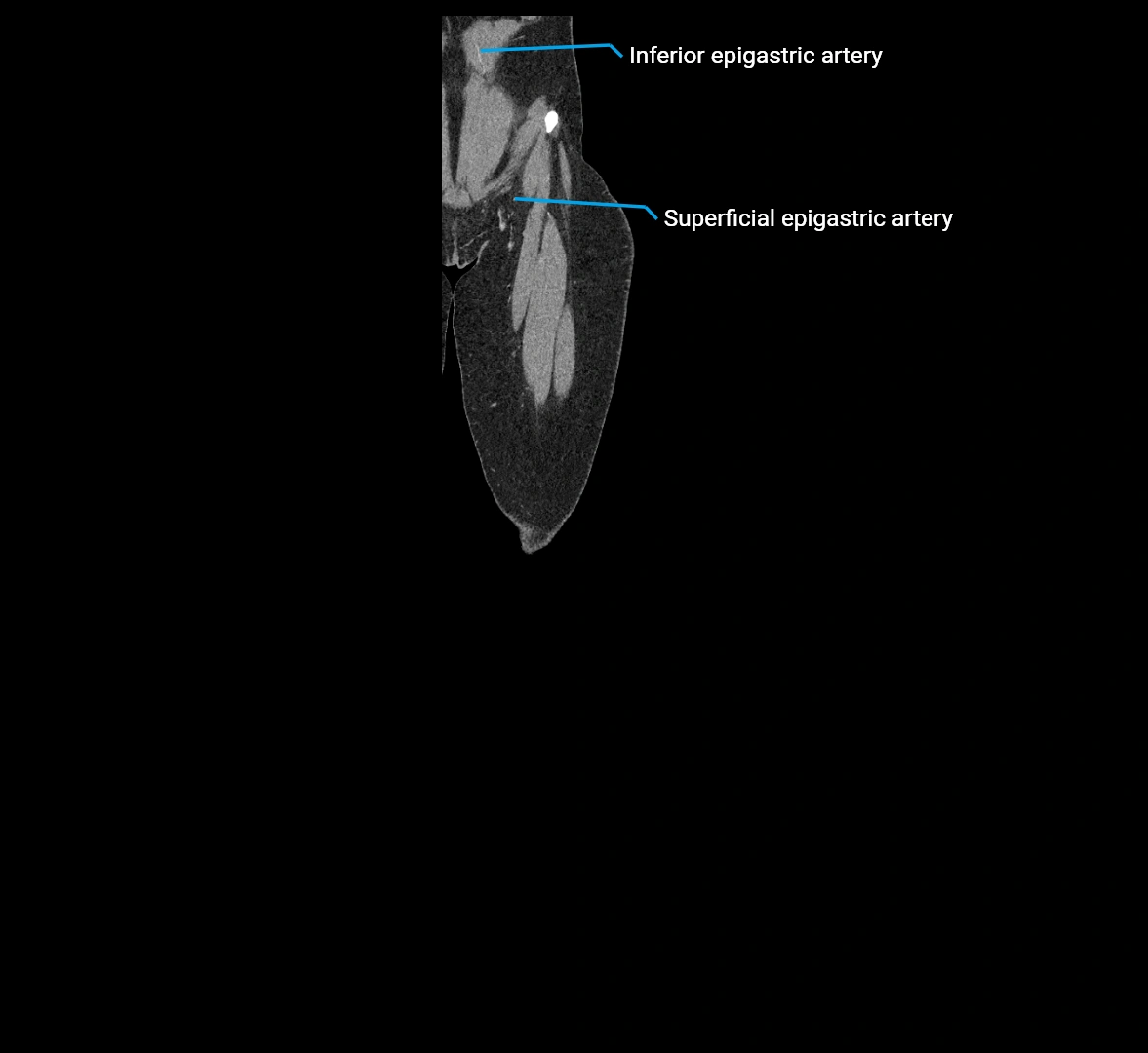 CTA lower limb coronal cross sectional anatomy labelled image _7 (1).webp